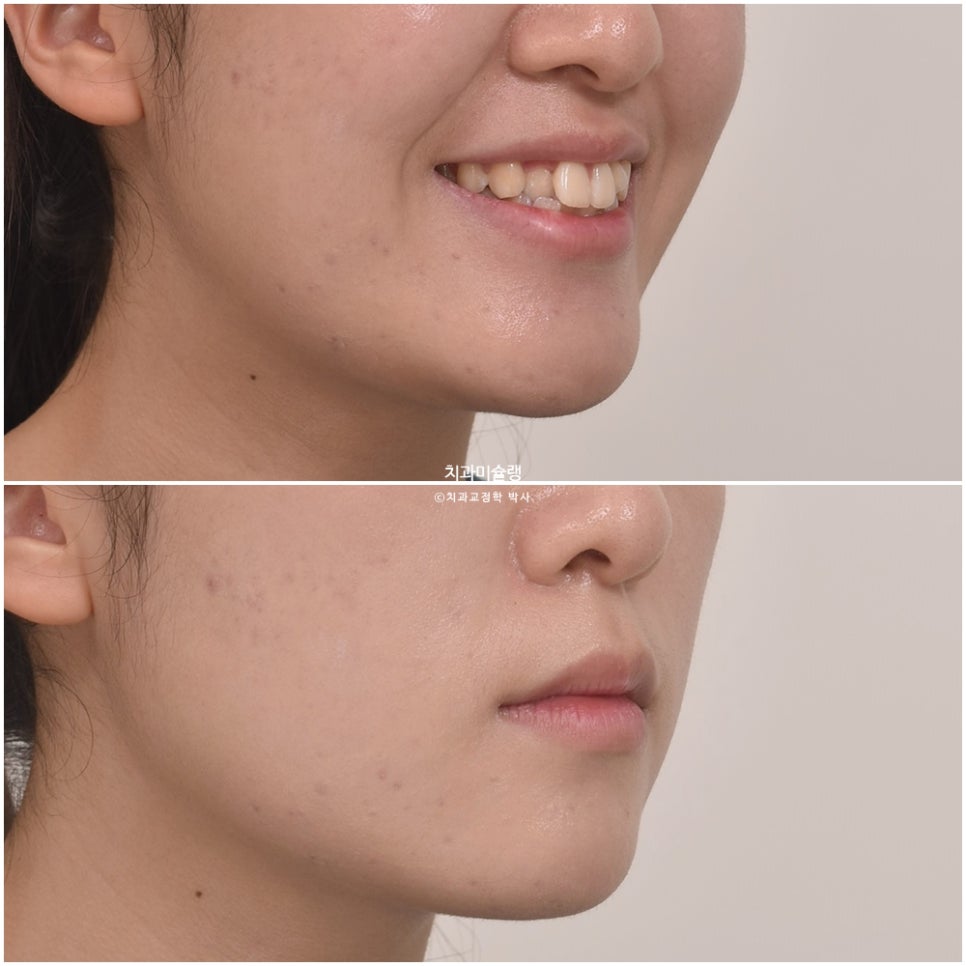 비발치 덧니 반대교합 후방이동 인비절라인 교정 중심선 치료기간 1년 6개월 재제작 1회