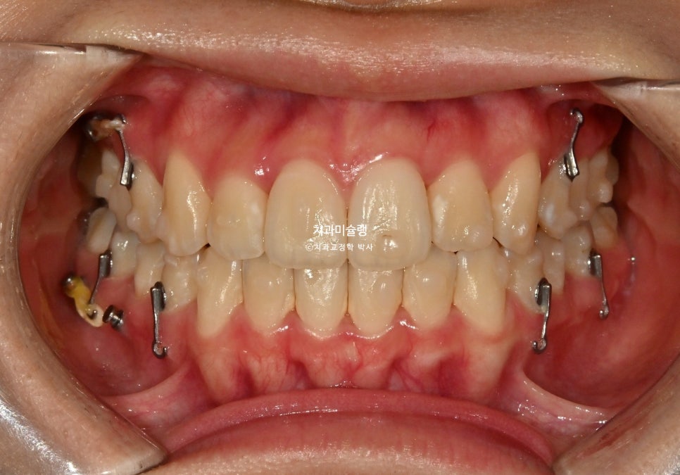 비발치 덧니 반대교합 후방이동 인비절라인 교정 중심선 치료기간 1년 6개월 재제작 1회