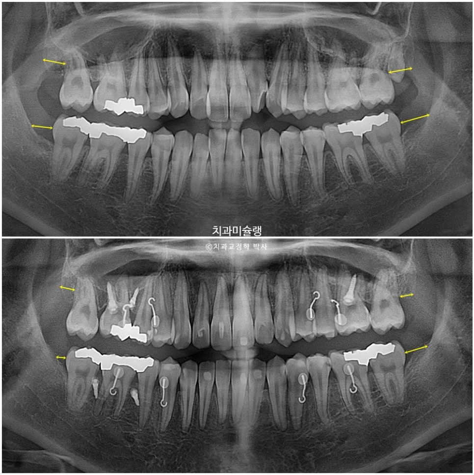 비발치 덧니 반대교합 후방이동 인비절라인 교정 중심선 치료기간 1년 6개월 재제작 1회