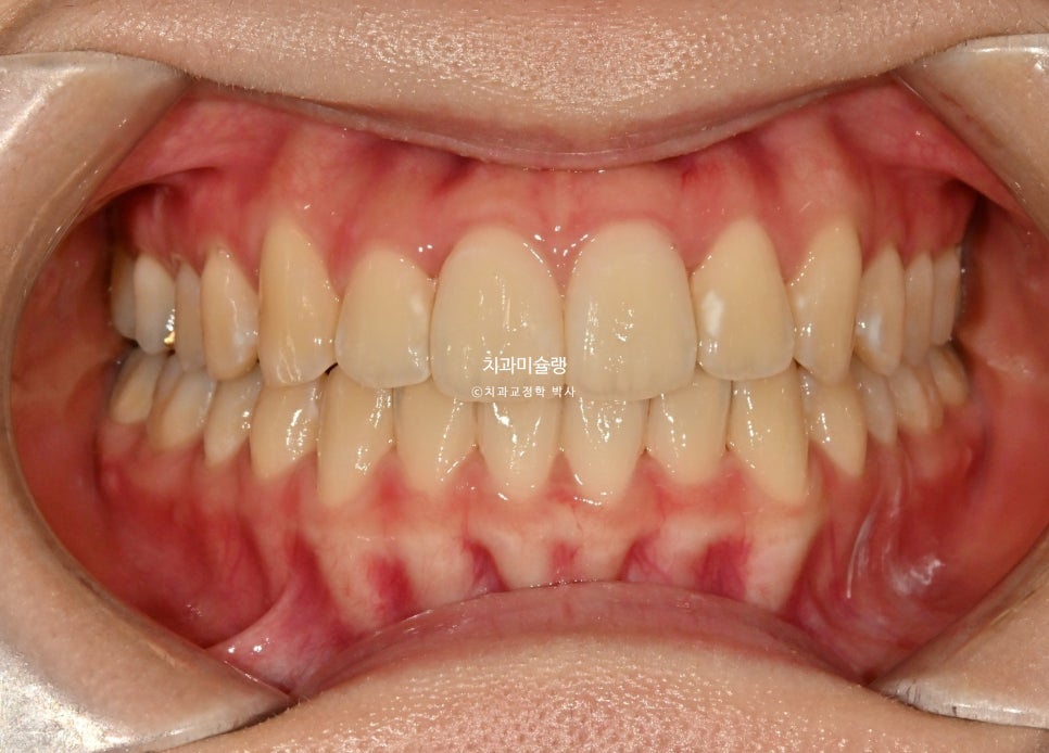 비발치 덧니 반대교합 후방이동 인비절라인 교정 중심선 치료기간 1년 6개월 재제작 1회