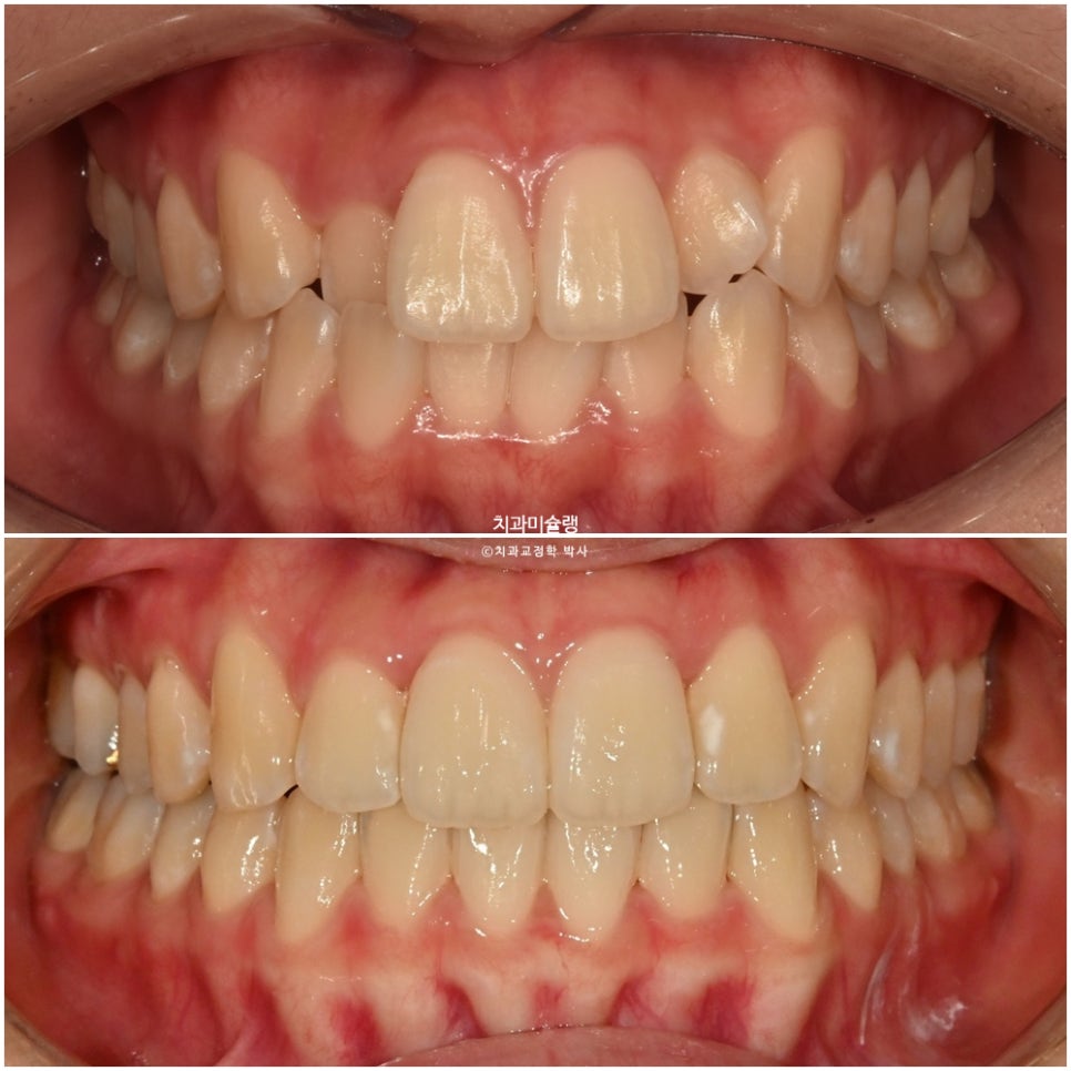 비발치 덧니 반대교합 후방이동 인비절라인 교정 중심선 치료기간 1년 6개월 재제작 1회