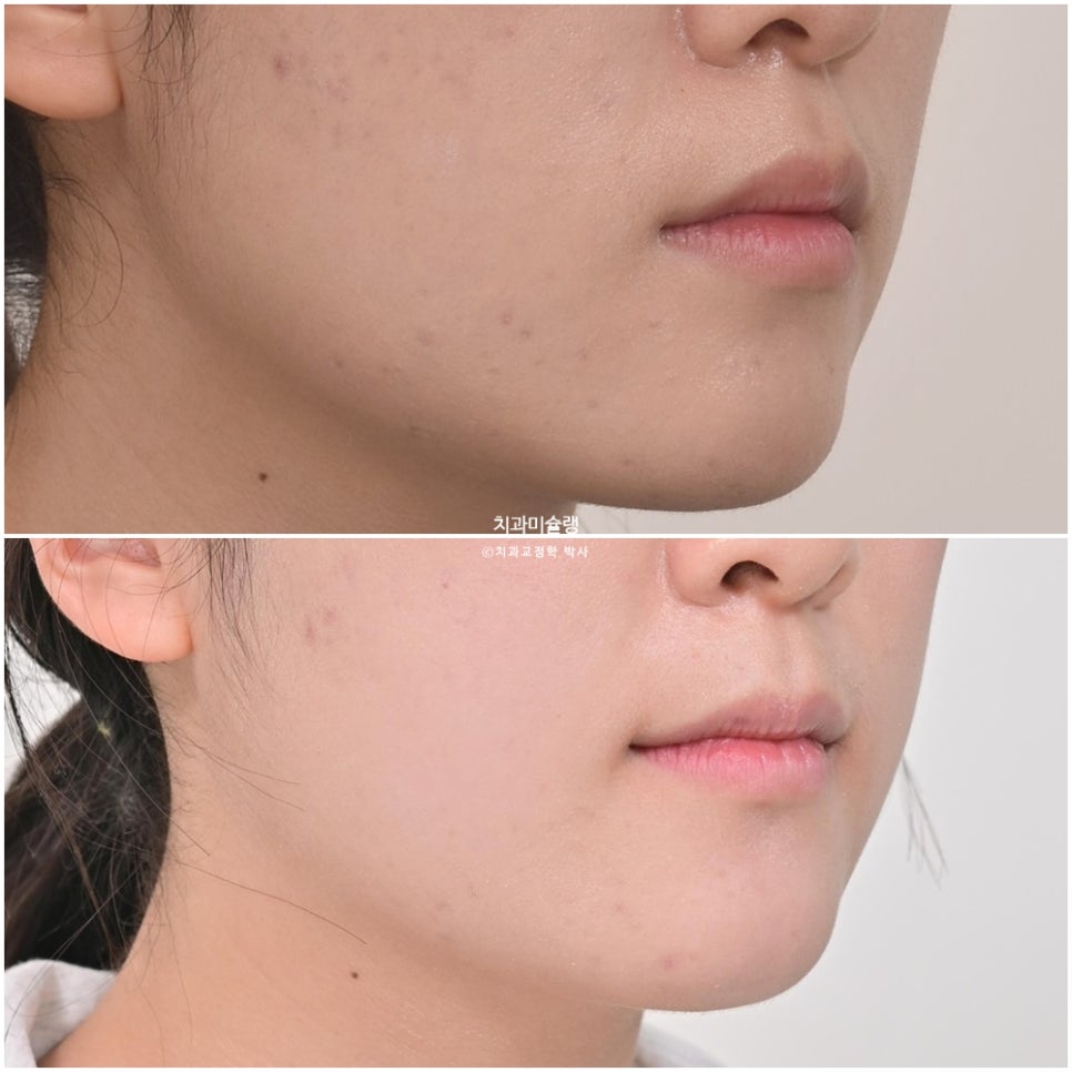 비발치 덧니 반대교합 후방이동 인비절라인 교정 중심선 치료기간 1년 6개월 재제작 1회