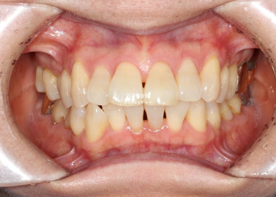 50대 돌출 앞니 부분교정 MTA 미니튜브 블랙트라이앵글 입술부전증 호두턱 자갈턱 치료기간 9개월