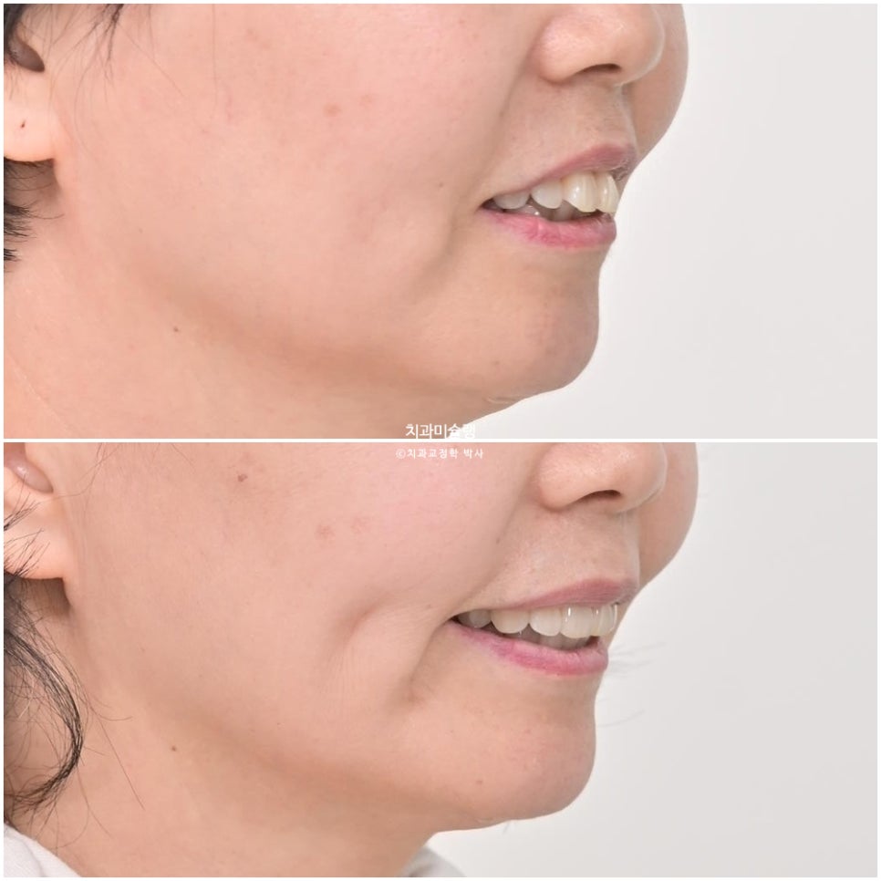 50대 돌출 앞니 부분교정 MTA 미니튜브 블랙트라이앵글 입술부전증 호두턱 자갈턱 치료기간 9개월