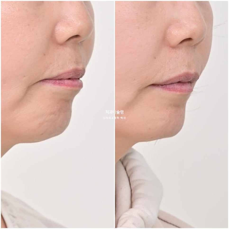 50대 돌출 앞니 부분교정 MTA 미니튜브 블랙트라이앵글 입술부전증 호두턱 자갈턱 치료기간 9개월