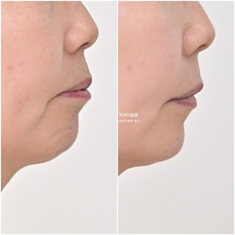 50대 돌출 앞니 부분교정 MTA 미니튜브 블랙트라이앵글 입술부전증 호두턱 자갈턱 치료기간 9개월