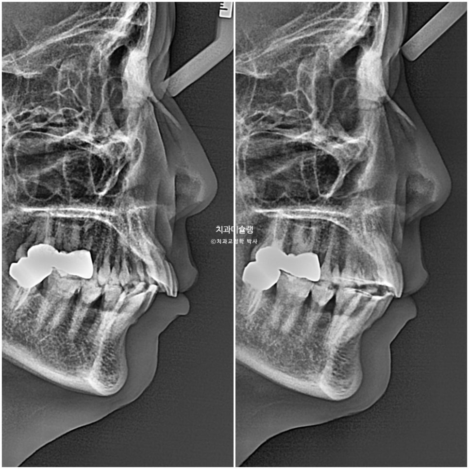 50대 돌출 앞니 부분교정 MTA 미니튜브 블랙트라이앵글 입술부전증 호두턱 자갈턱 치료기간 9개월
