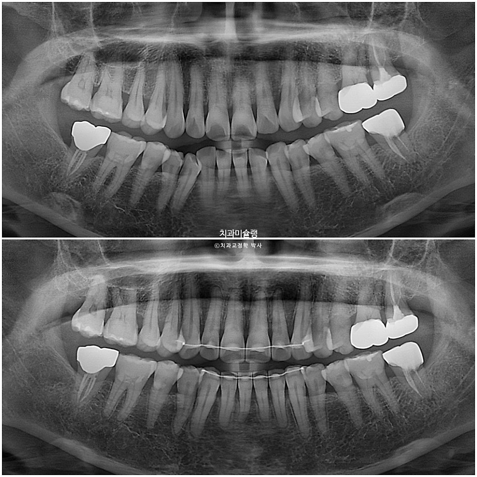 50대 돌출 앞니 부분교정 MTA 미니튜브 블랙트라이앵글 입술부전증 호두턱 자갈턱 치료기간 9개월
