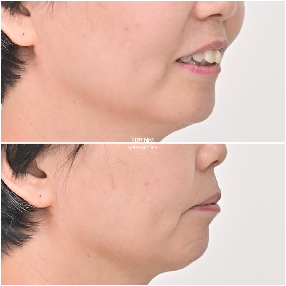 50대 돌출 앞니 부분교정 MTA 미니튜브 블랙트라이앵글 입술부전증 호두턱 자갈턱 치료기간 9개월