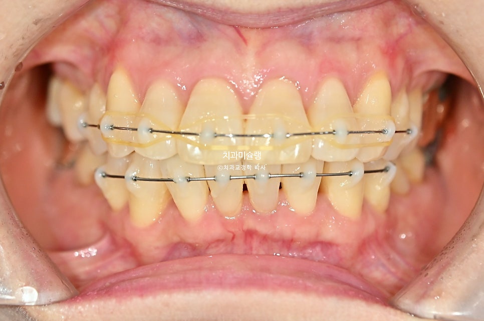 50대 돌출 앞니 부분교정 MTA 미니튜브 블랙트라이앵글 입술부전증 호두턱 자갈턱 치료기간 9개월