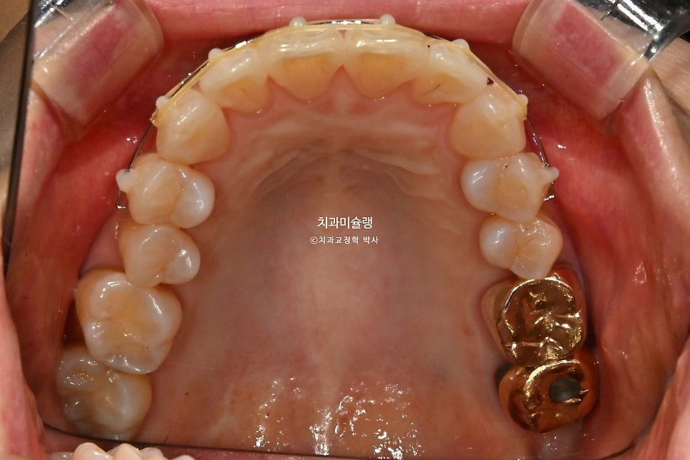 50대 돌출 앞니 부분교정 MTA 미니튜브 블랙트라이앵글 입술부전증 호두턱 자갈턱 치료기간 9개월