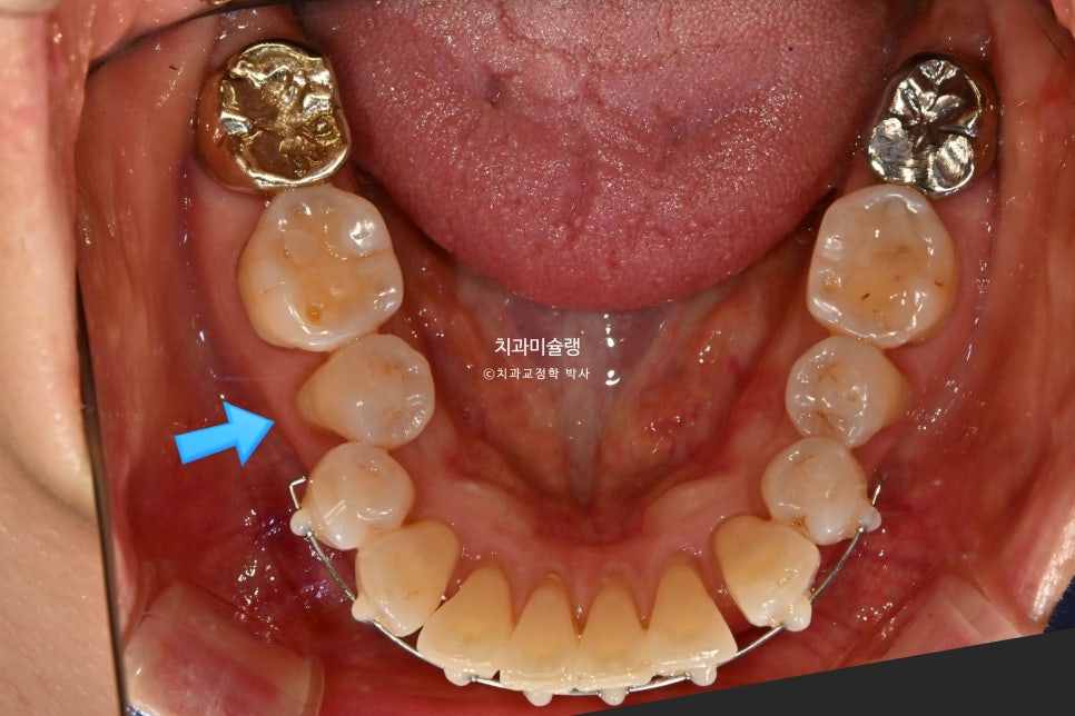 50대 돌출 앞니 부분교정 MTA 미니튜브 블랙트라이앵글 입술부전증 호두턱 자갈턱 치료기간 9개월