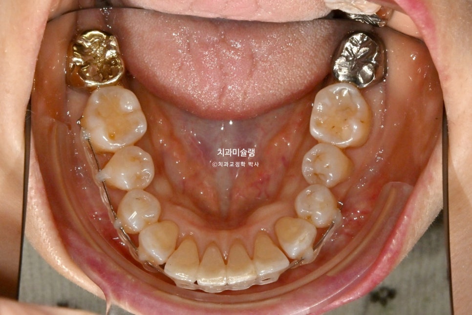 50대 돌출 앞니 부분교정 MTA 미니튜브 블랙트라이앵글 입술부전증 호두턱 자갈턱 치료기간 9개월