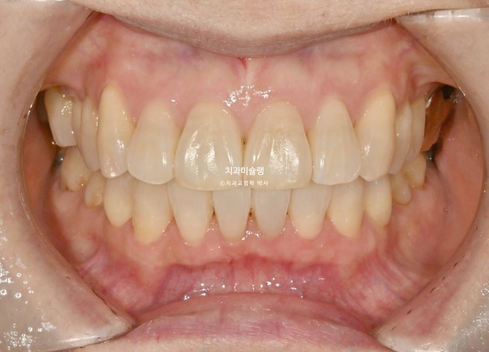 50대 돌출 앞니 부분교정 MTA 미니튜브 블랙트라이앵글 입술부전증 호두턱 자갈턱 치료기간 9개월