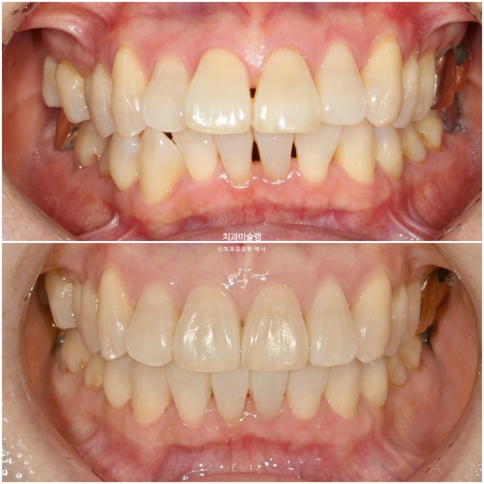 50대 돌출 앞니 부분교정 MTA 미니튜브 블랙트라이앵글 입술부전증 호두턱 자갈턱 치료기간 9개월
