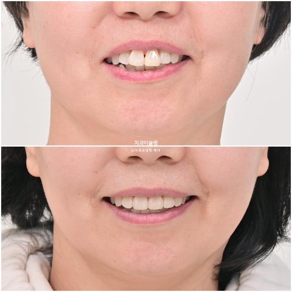 50대 돌출 앞니 부분교정 MTA 미니튜브 블랙트라이앵글 입술부전증 호두턱 자갈턱 치료기간 9개월