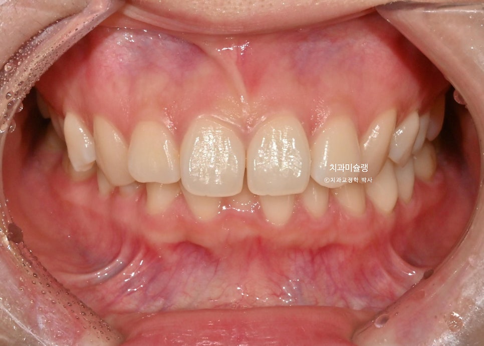 인비절라인 라이트 비발치 과개교합 돌출 중심선 고무줄 치료기간 9개월 재제작 1회