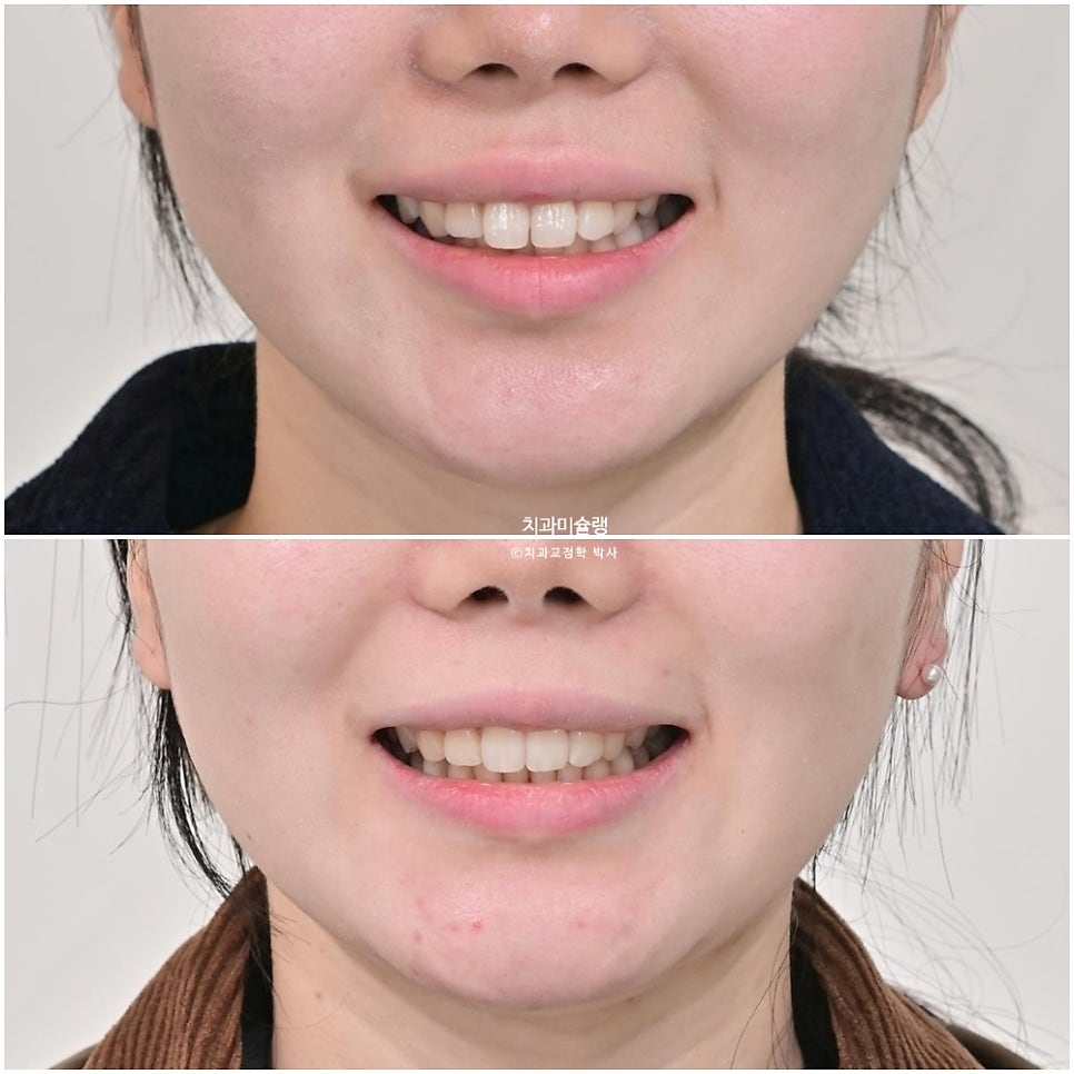 인비절라인 라이트 비발치 과개교합 돌출 중심선 고무줄 치료기간 9개월 재제작 1회