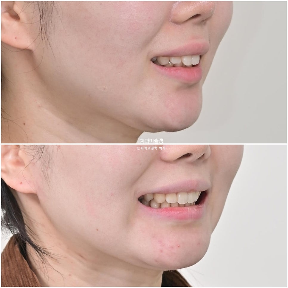 인비절라인 라이트 비발치 과개교합 돌출 중심선 고무줄 치료기간 9개월 재제작 1회