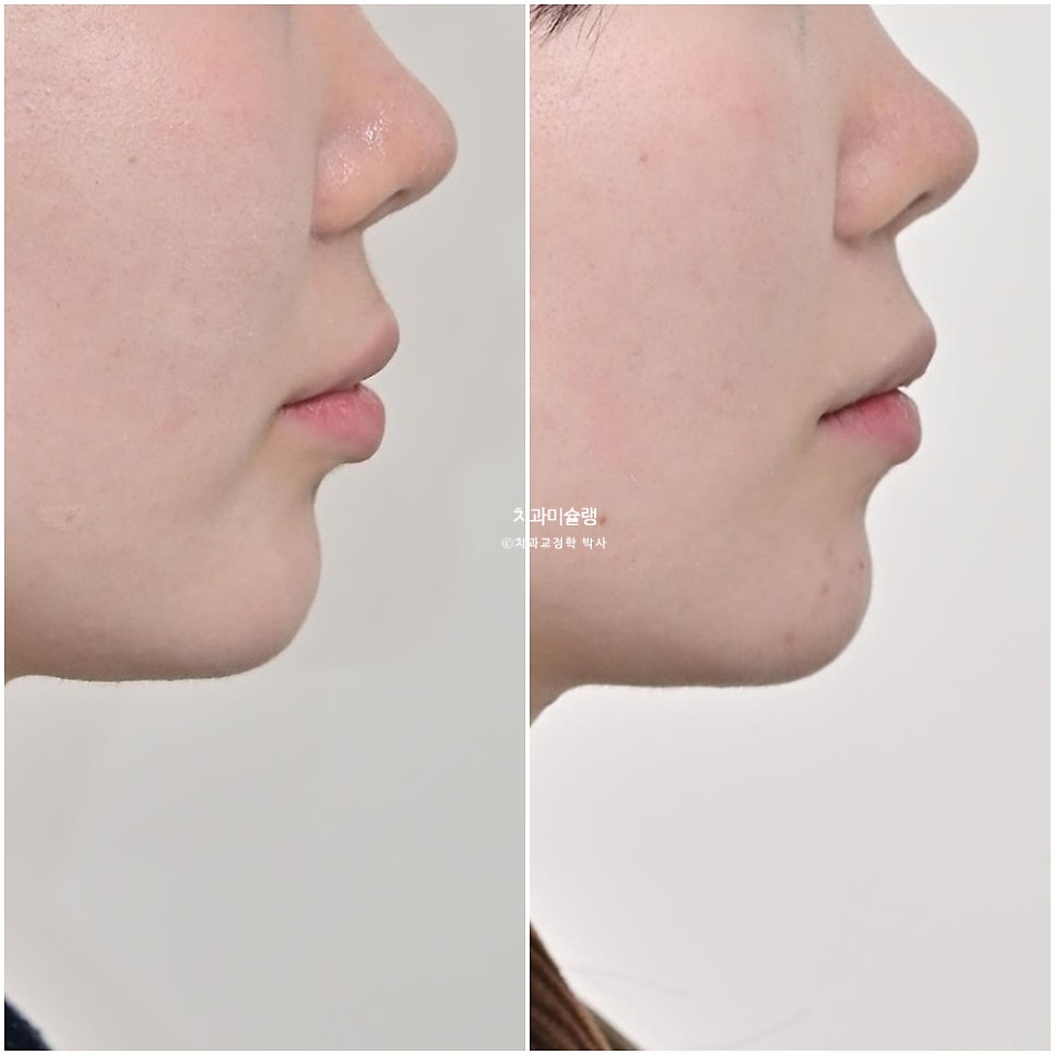 인비절라인 라이트 비발치 과개교합 돌출 중심선 고무줄 치료기간 9개월 재제작 1회