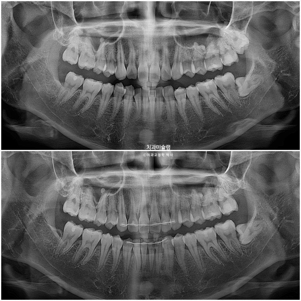 인비절라인 라이트 비발치 과개교합 돌출 중심선 고무줄 치료기간 9개월 재제작 1회