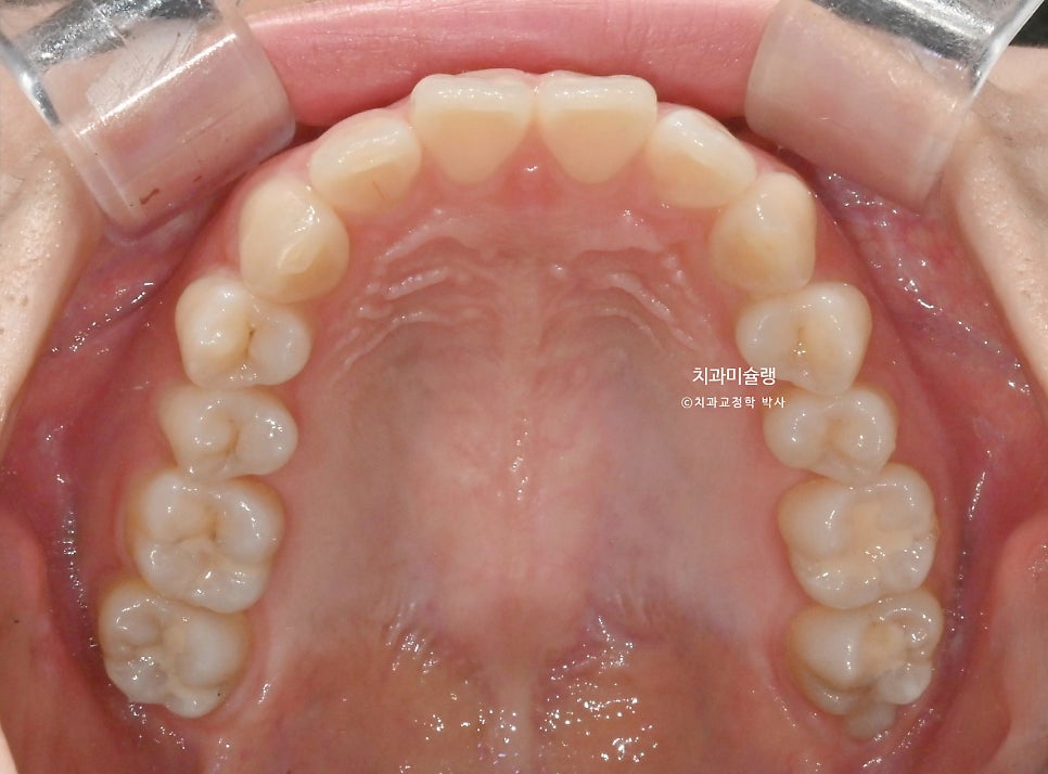 인비절라인 라이트 비발치 과개교합 돌출 중심선 고무줄 치료기간 9개월 재제작 1회