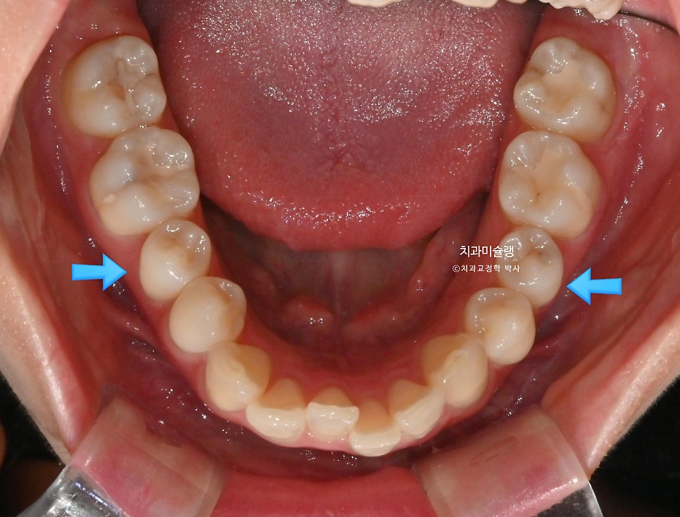 인비절라인 라이트 비발치 과개교합 돌출 중심선 고무줄 치료기간 9개월 재제작 1회