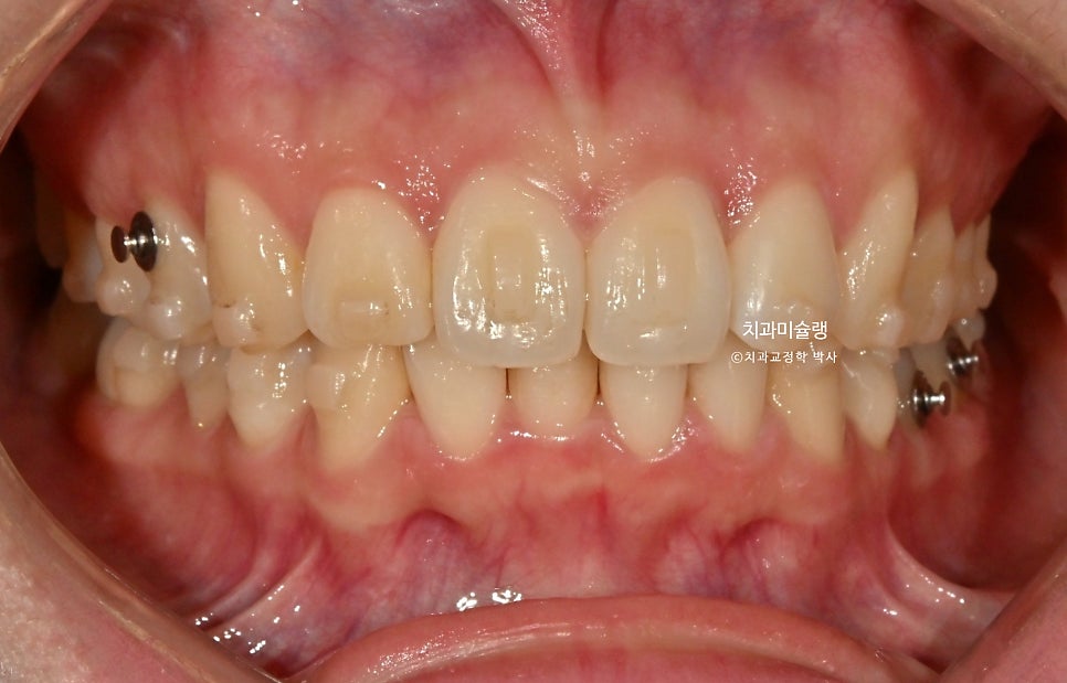 인비절라인 라이트 비발치 과개교합 돌출 중심선 고무줄 치료기간 9개월 재제작 1회