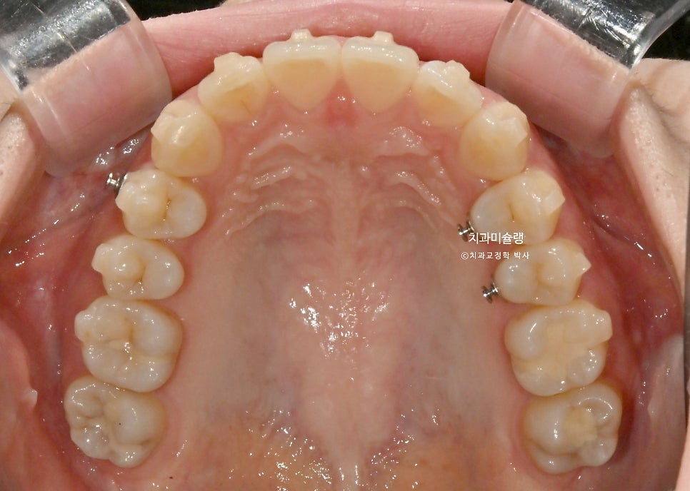 인비절라인 라이트 비발치 과개교합 돌출 중심선 고무줄 치료기간 9개월 재제작 1회