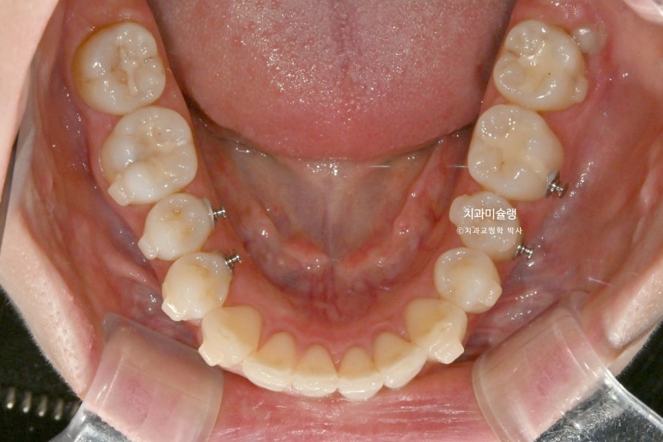 인비절라인 라이트 비발치 과개교합 돌출 중심선 고무줄 치료기간 9개월 재제작 1회