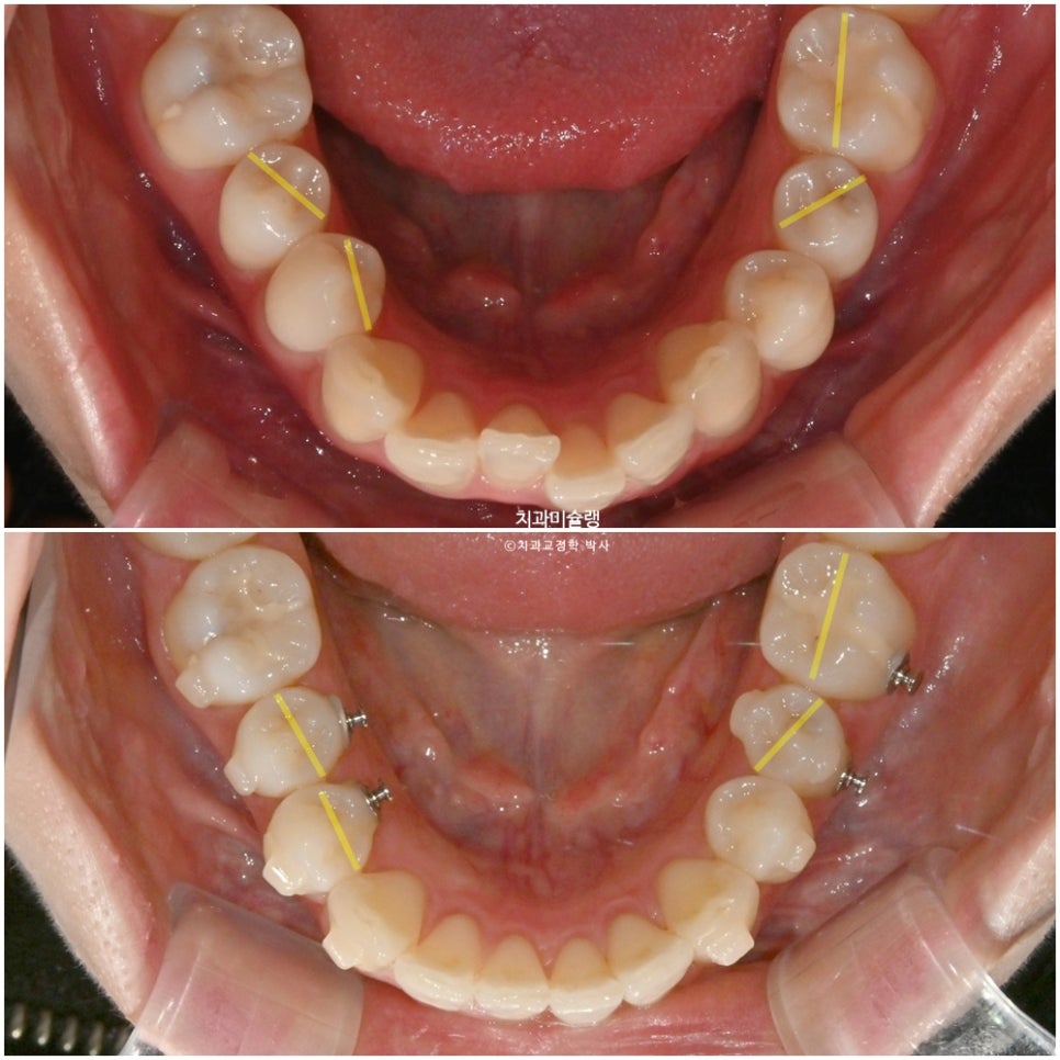 인비절라인 라이트 비발치 과개교합 돌출 중심선 고무줄 치료기간 9개월 재제작 1회