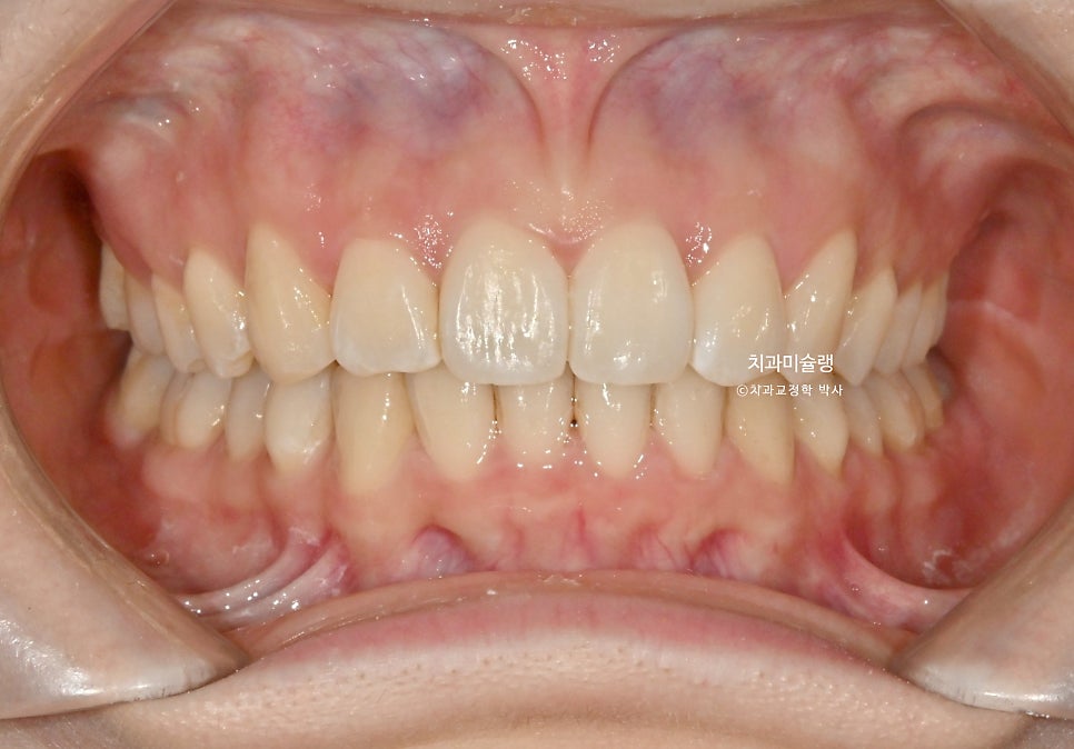 인비절라인 라이트 비발치 과개교합 돌출 중심선 고무줄 치료기간 9개월 재제작 1회