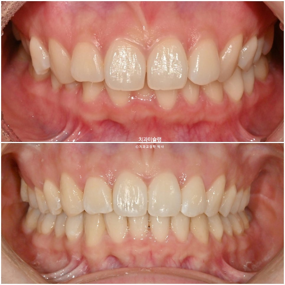 인비절라인 라이트 비발치 과개교합 돌출 중심선 고무줄 치료기간 9개월 재제작 1회