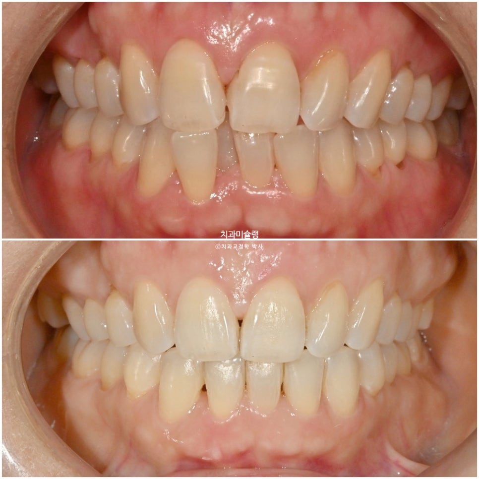 50대 부분교정 하악 전치 발치교정 선천적 결손 3전치 반대교합 블랙트라이앵글 치간삭제 치료기간 8개월