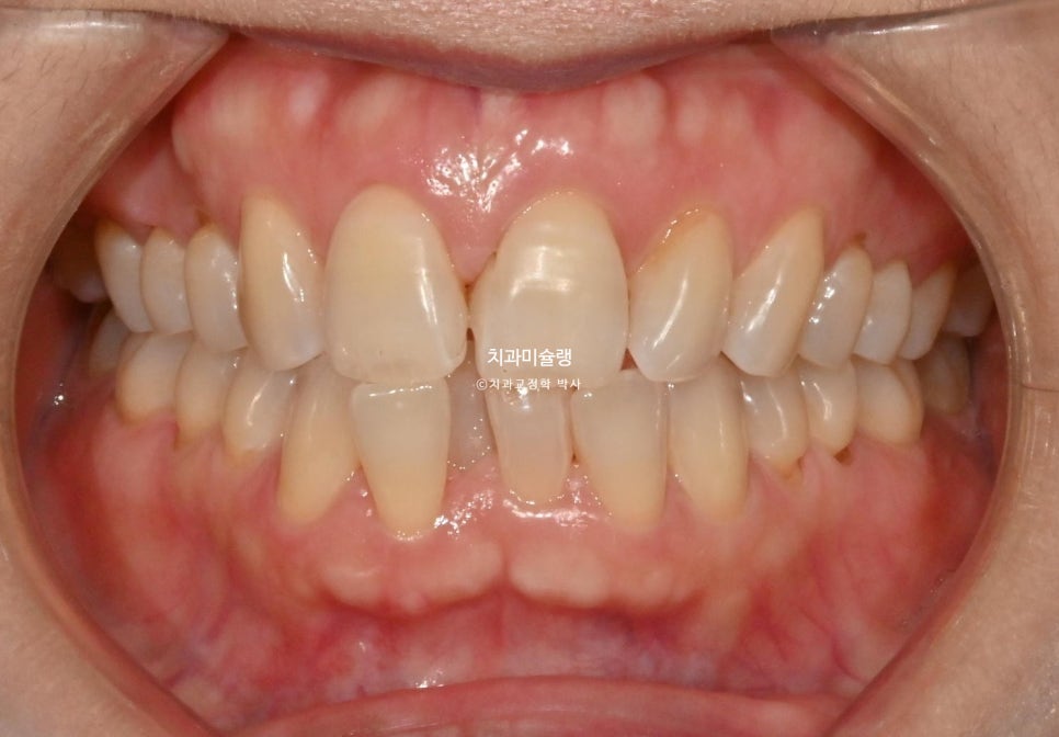 50대 부분교정 하악 전치 발치교정 선천적 결손 3전치 반대교합 블랙트라이앵글 치간삭제 치료기간 8개월