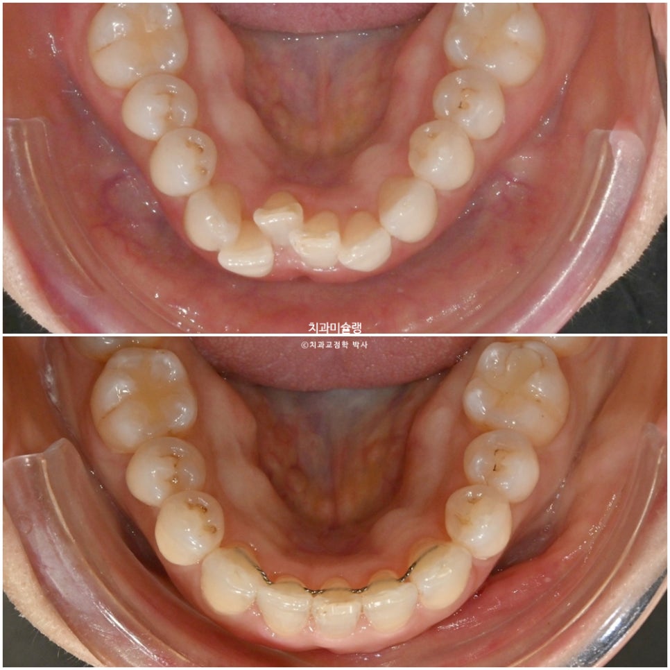 50대 부분교정 하악 전치 발치교정 선천적 결손 3전치 반대교합 블랙트라이앵글 치간삭제 치료기간 8개월