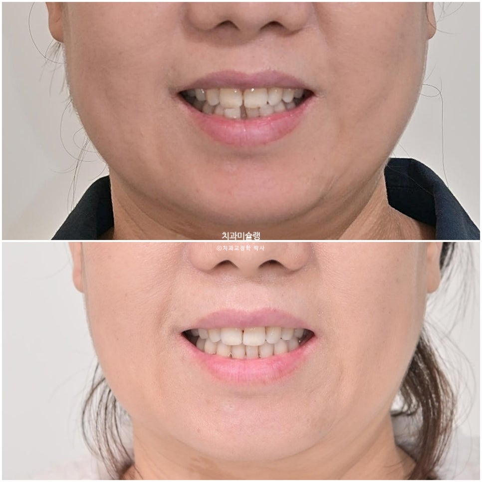 50대 부분교정 하악 전치 발치교정 선천적 결손 3전치 반대교합 블랙트라이앵글 치간삭제 치료기간 8개월