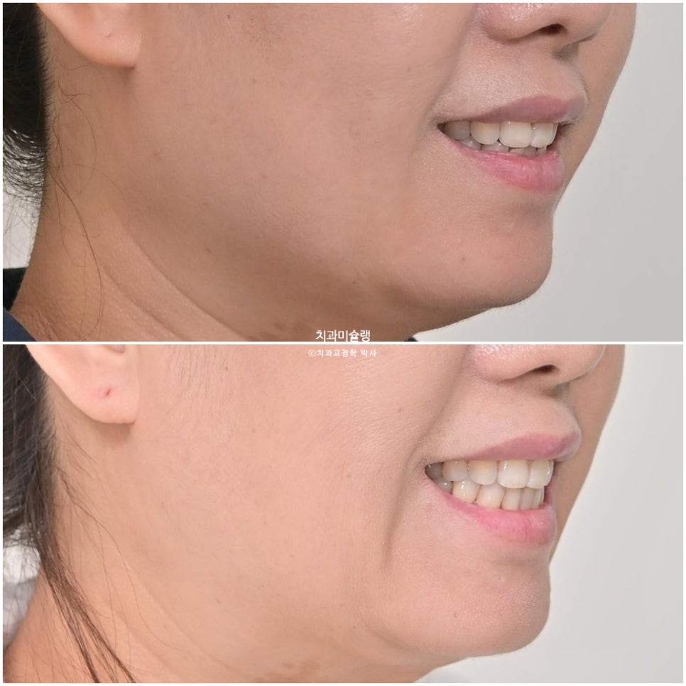 50대 부분교정 하악 전치 발치교정 선천적 결손 3전치 반대교합 블랙트라이앵글 치간삭제 치료기간 8개월