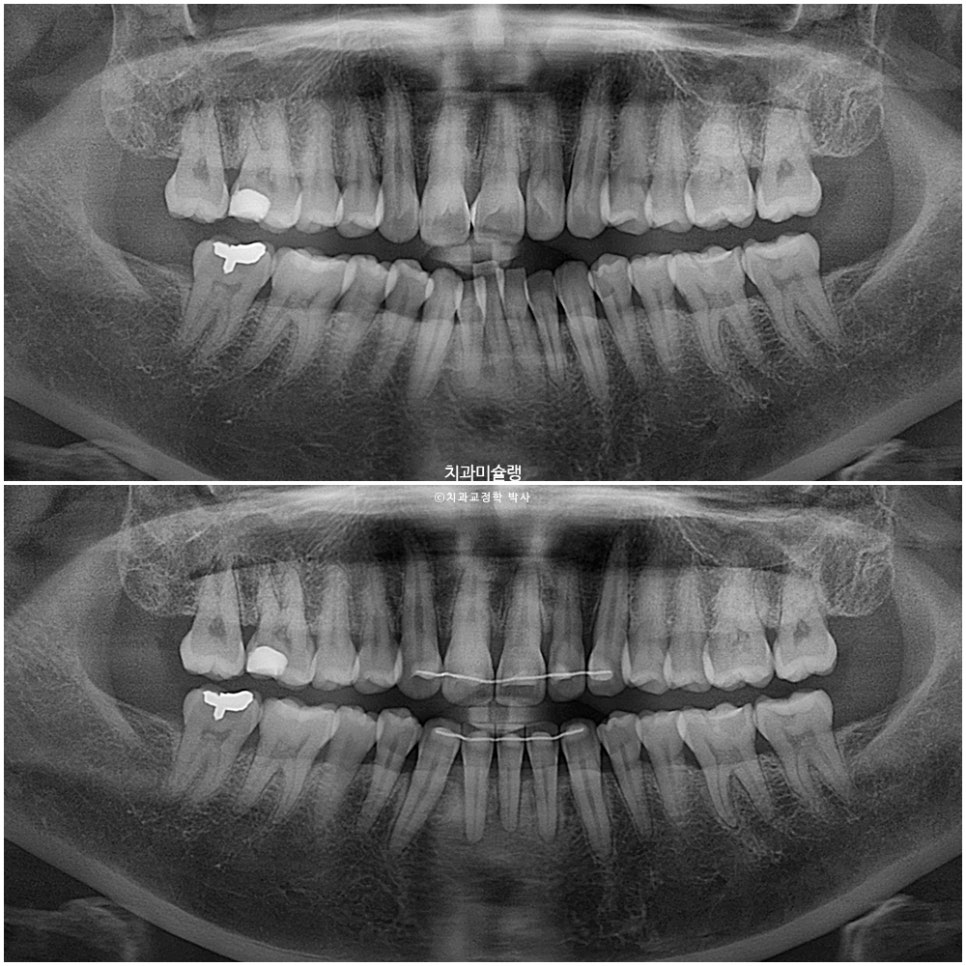 50대 부분교정 하악 전치 발치교정 선천적 결손 3전치 반대교합 블랙트라이앵글 치간삭제 치료기간 8개월