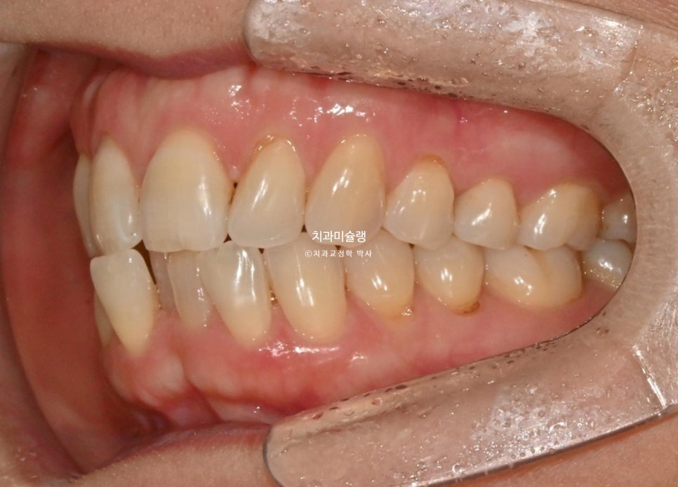 50대 부분교정 하악 전치 발치교정 선천적 결손 3전치 반대교합 블랙트라이앵글 치간삭제 치료기간 8개월