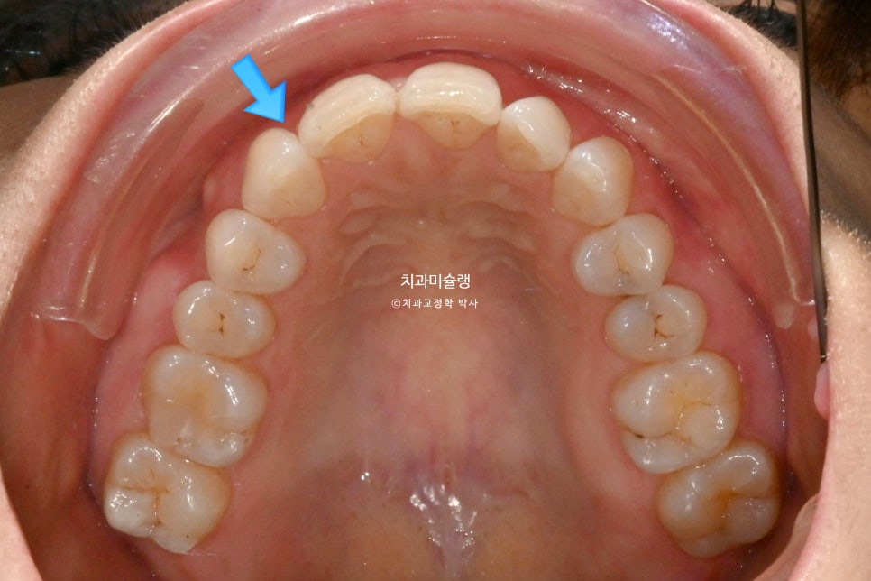 50대 부분교정 하악 전치 발치교정 선천적 결손 3전치 반대교합 블랙트라이앵글 치간삭제 치료기간 8개월
