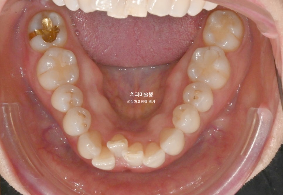 50대 부분교정 하악 전치 발치교정 선천적 결손 3전치 반대교합 블랙트라이앵글 치간삭제 치료기간 8개월