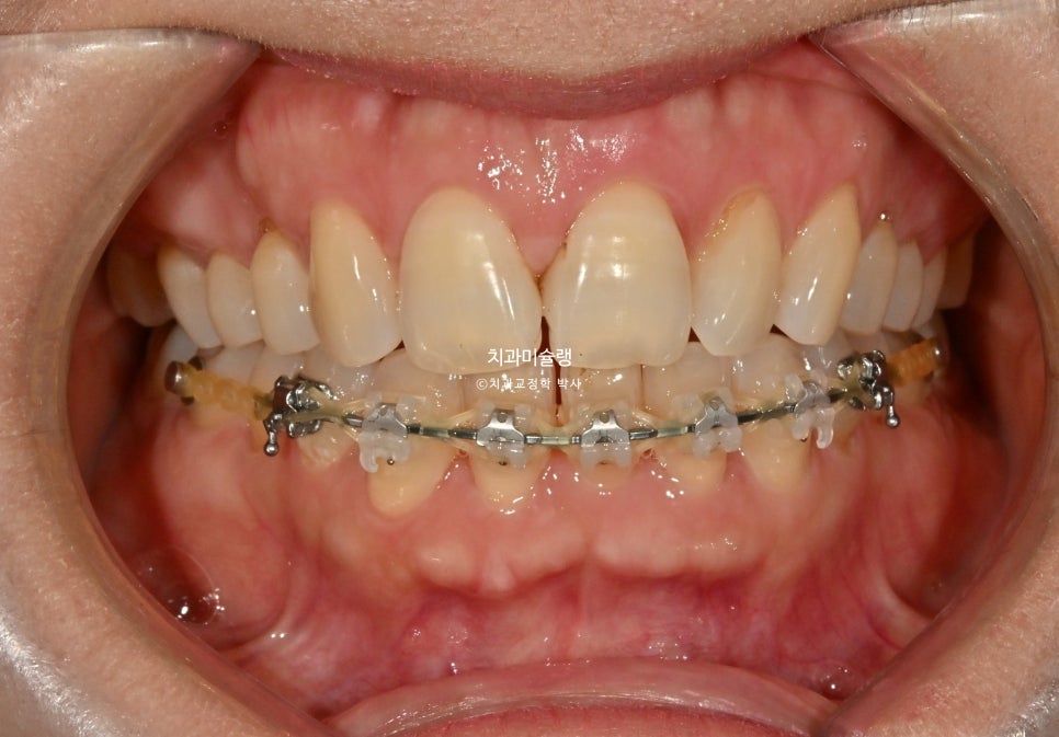 50대 부분교정 하악 전치 발치교정 선천적 결손 3전치 반대교합 블랙트라이앵글 치간삭제 치료기간 8개월