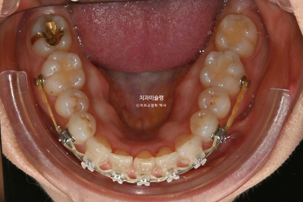 50대 부분교정 하악 전치 발치교정 선천적 결손 3전치 반대교합 블랙트라이앵글 치간삭제 치료기간 8개월