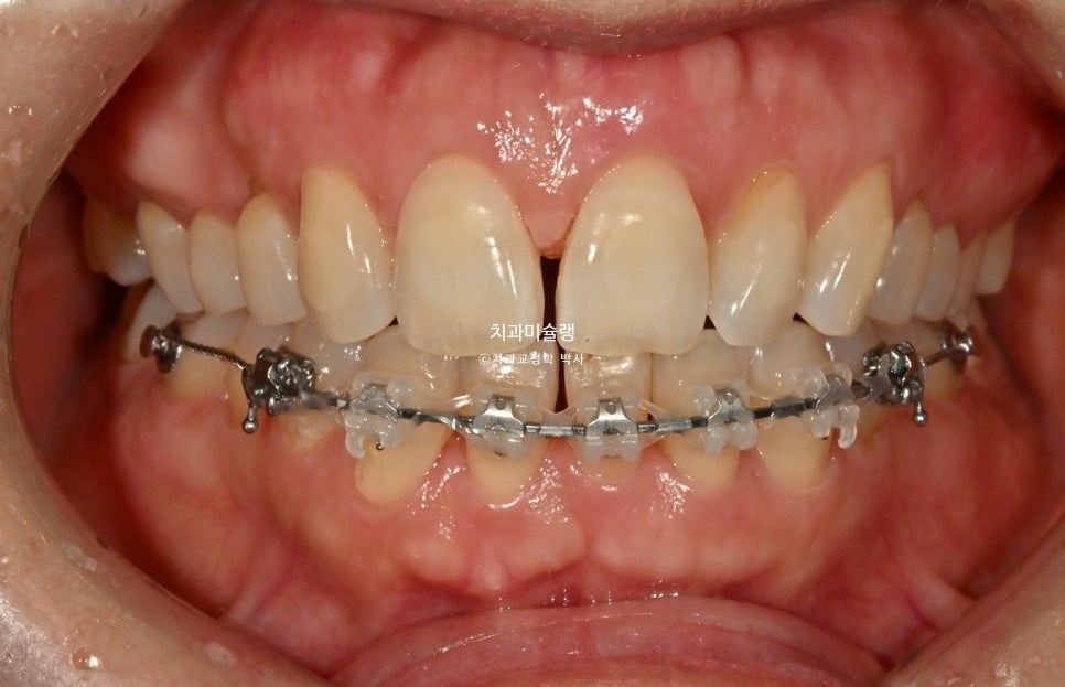50대 부분교정 하악 전치 발치교정 선천적 결손 3전치 반대교합 블랙트라이앵글 치간삭제 치료기간 8개월