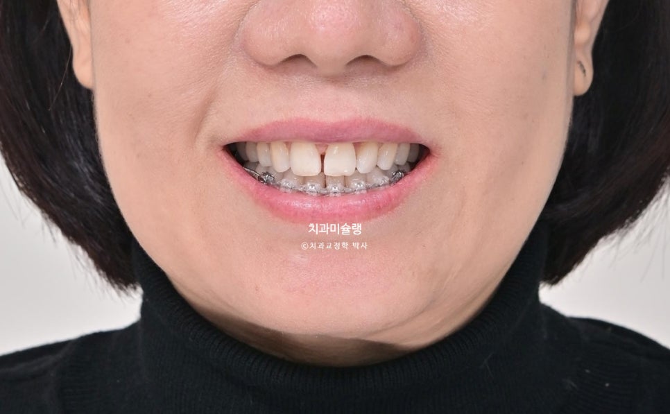 50대 부분교정 하악 전치 발치교정 선천적 결손 3전치 반대교합 블랙트라이앵글 치간삭제 치료기간 8개월