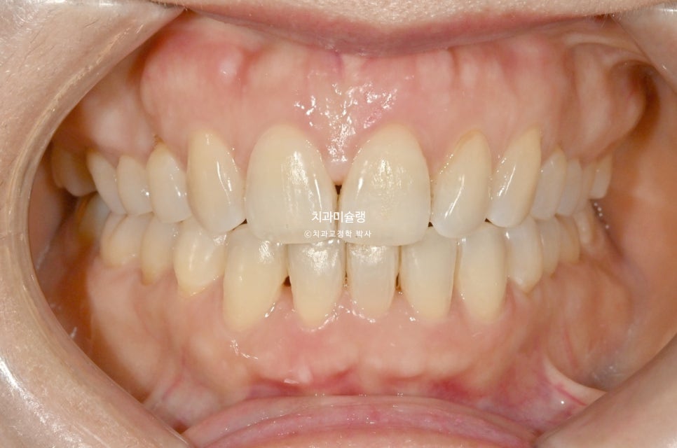 50대 부분교정 하악 전치 발치교정 선천적 결손 3전치 반대교합 블랙트라이앵글 치간삭제 치료기간 8개월