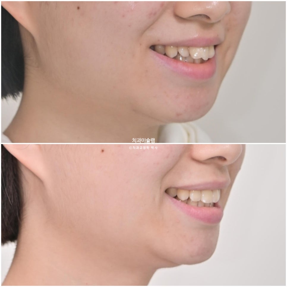 비발치 인비절라인 선천적 결손 3전치 치간삭제 배열위주 교정 치료기간 1년 재제작 1회