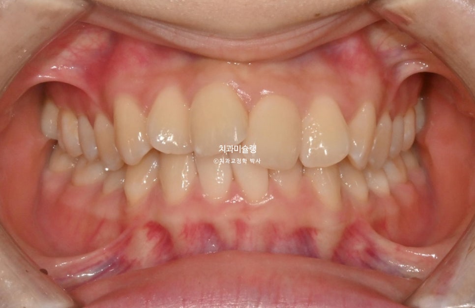 비발치 인비절라인 선천적 결손 3전치 치간삭제 배열위주 교정 치료기간 1년 재제작 1회
