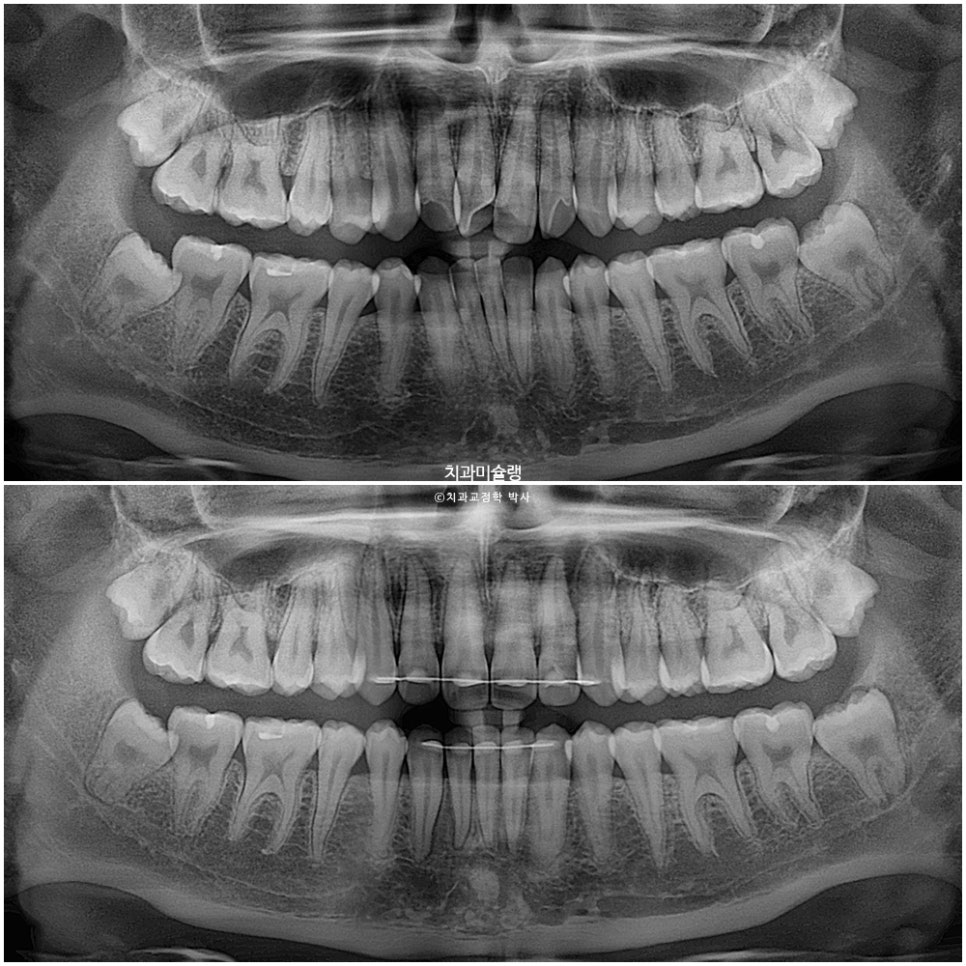 비발치 인비절라인 선천적 결손 3전치 치간삭제 배열위주 교정 치료기간 1년 재제작 1회